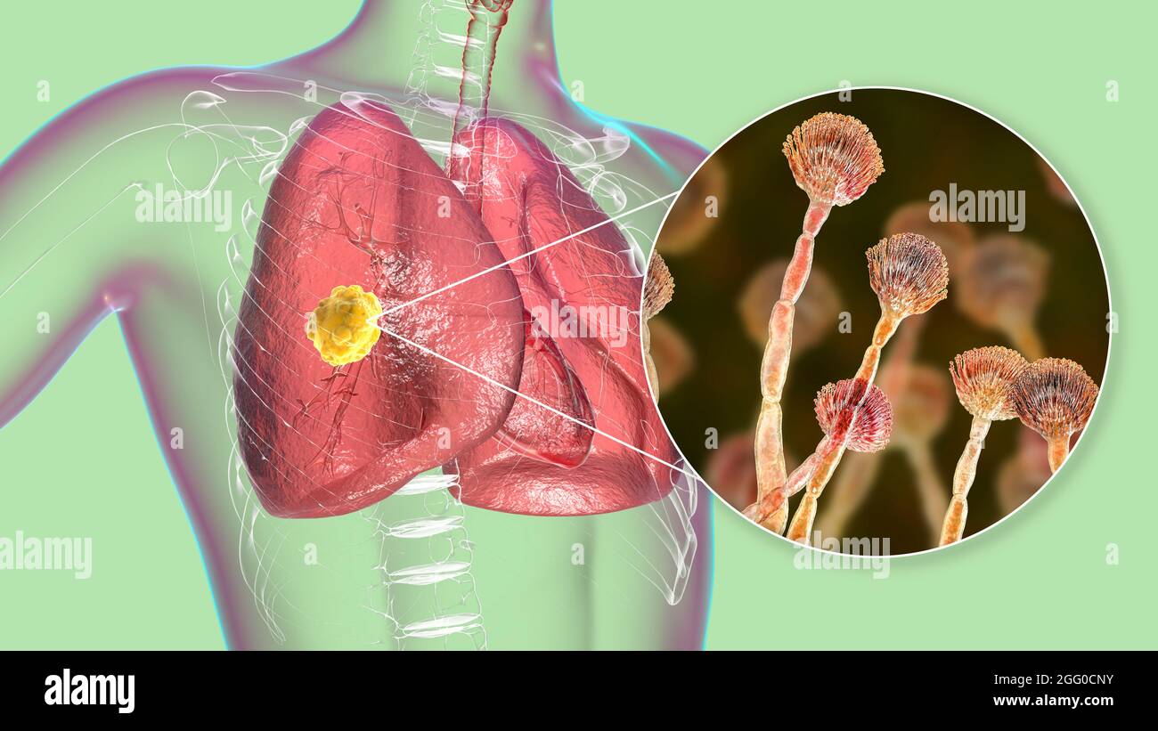 Illustrazione di un aspergillosi polmonare, invasione di un tessuto polmonare da funghi di stampo Aspergillus con vista ravvicinata dei funghi. Foto Stock