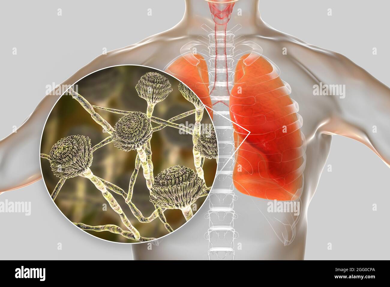 Illustrazione di un aspergillosi polmonare, invasione di un tessuto polmonare da funghi di stampo Aspergillus con vista ravvicinata dei funghi. Foto Stock
