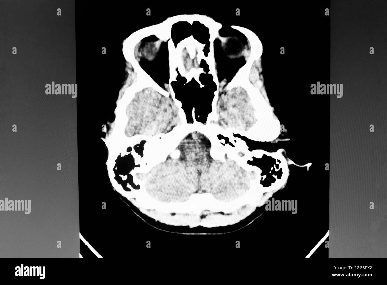 Immagine della tomografia computerizzata del cervello Foto Stock