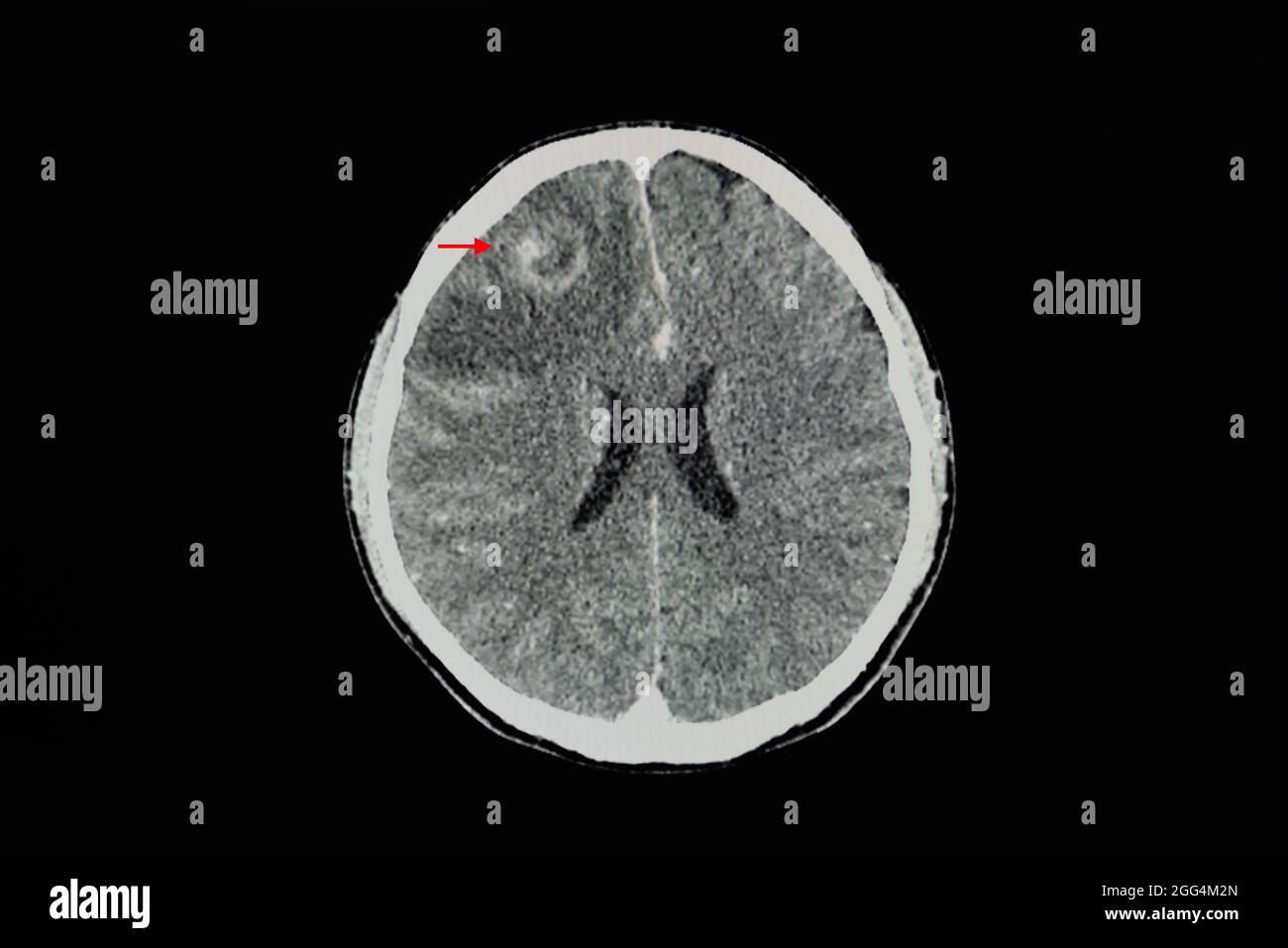 Una scansione cerebrale TC con contrasto di un paziente con lesione che migliora il bordo con edema cerebrale al lobo frontale destro. Foto Stock