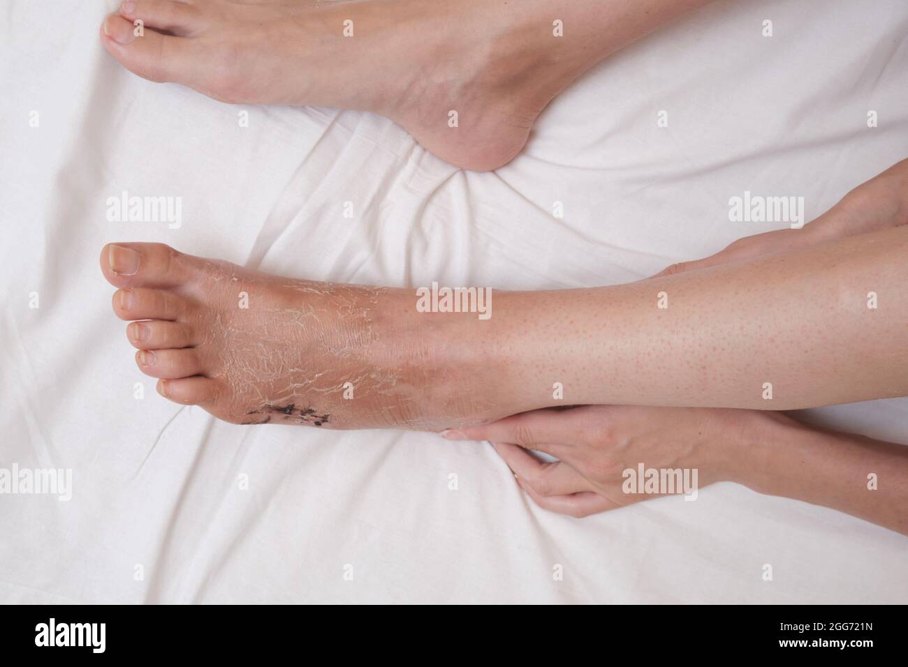Sutura postoperatoria sul piede, gamba dopo frattura e dopo rimozione della  bendatura in gesso Foto stock - Alamy