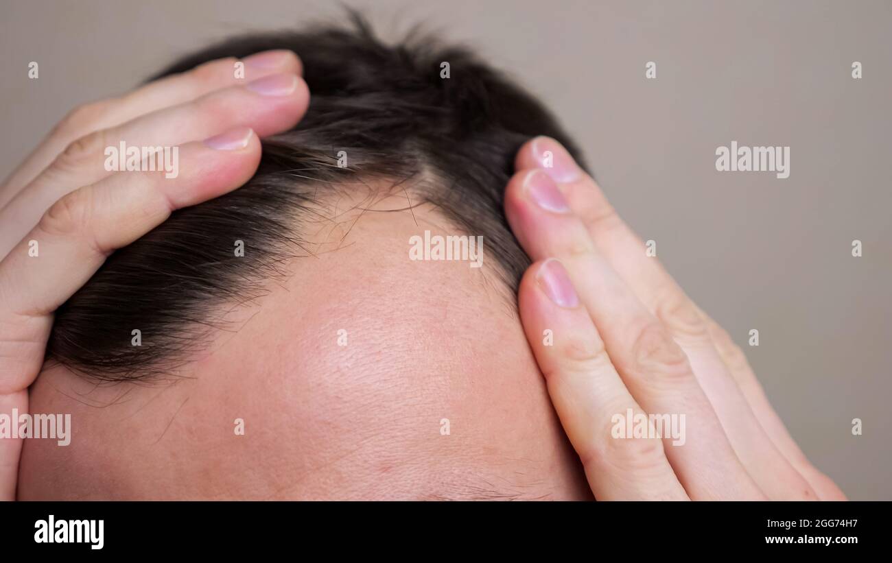 Uomo con macchie calde che soffrono di perdita di capelli. Trattamento del problema dei capelli Foto Stock