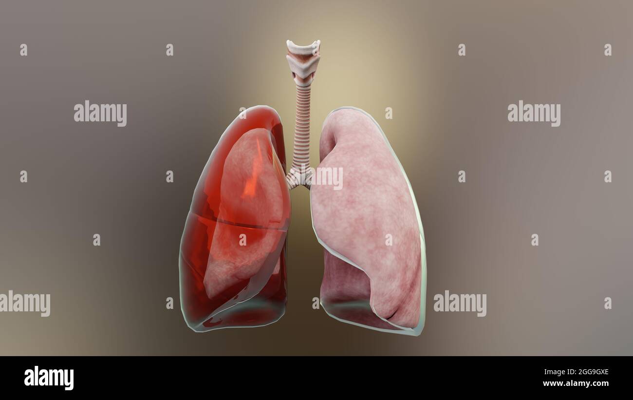 Illustrazione 3d di Emothorax, polmone normale versus collassato, sintomi di Emothorax, versamento pleurico, empyema, complicazioni dopo una lesione toracica, Foto Stock