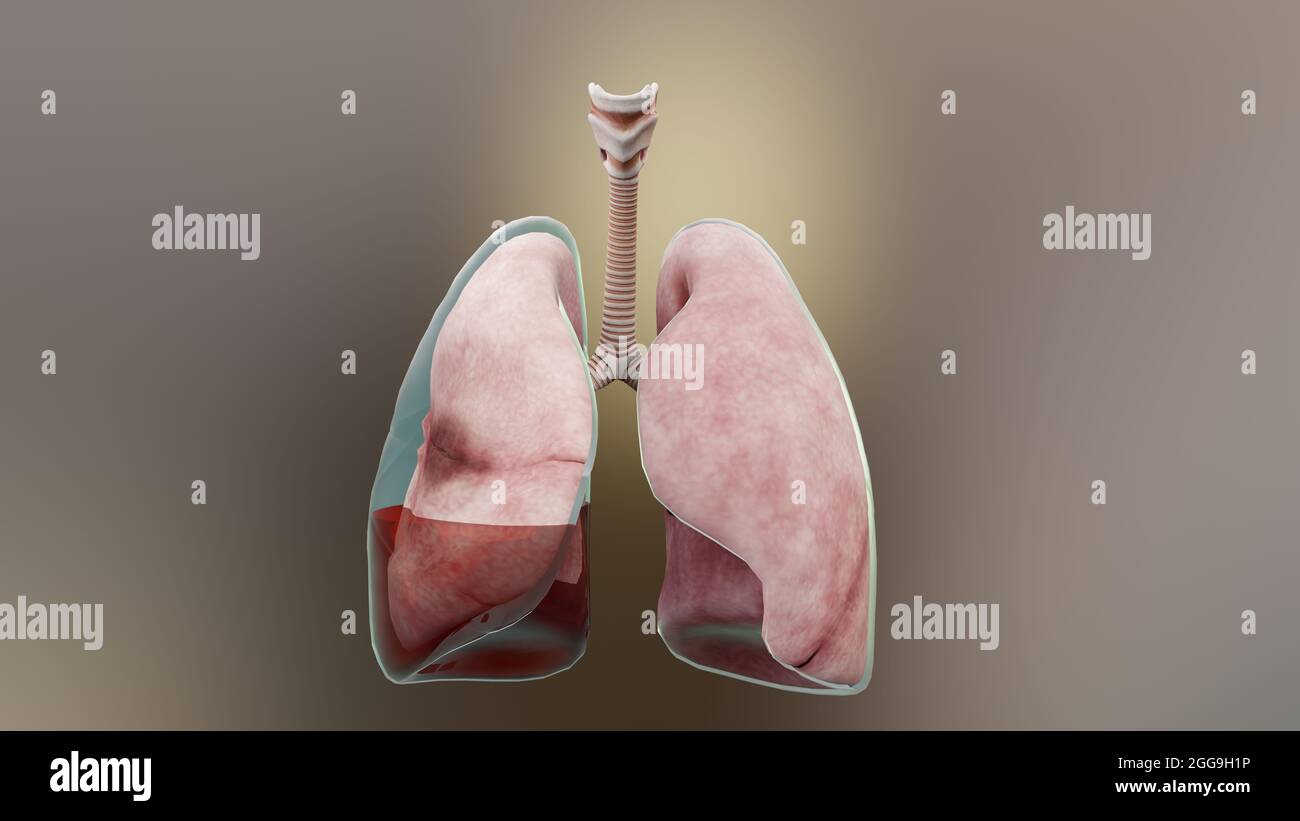 Illustrazione 3d di Hemopneumotorax, polmone normale contro collassato, sintomi di Hemopneumotorax, versamento pleurico, empyema, complicazioni Foto Stock