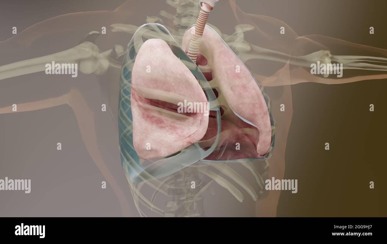 Illustrazione 3d di pneumotorace, polmone normale verso collassato, sintomi di pneumotorace, versamento pleurico, empyema, complicazioni dopo una lesione toracica Foto Stock