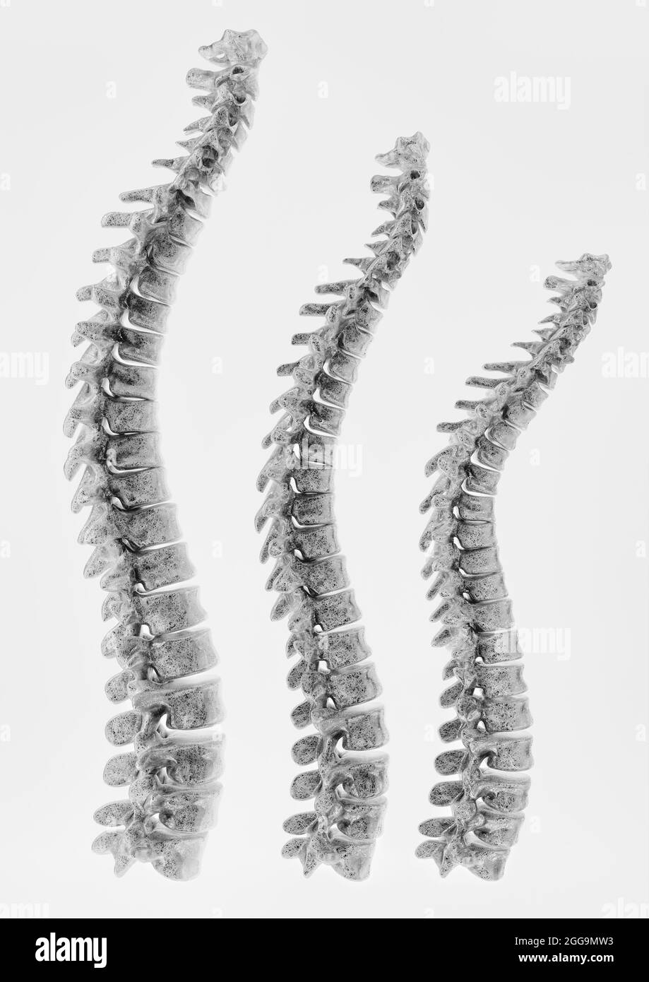 Panoramica della curvatura della colonna vertebrale su sfondo bianco - rendering 3D Foto Stock