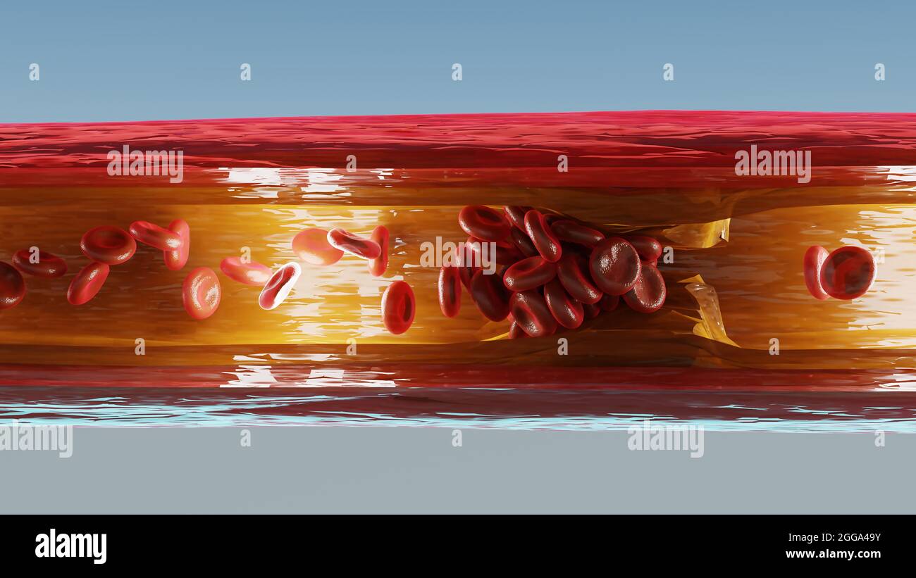 Malattia di aterosclerosi. Blocco del flusso di sangue da peste. illustrazione 3d Foto Stock