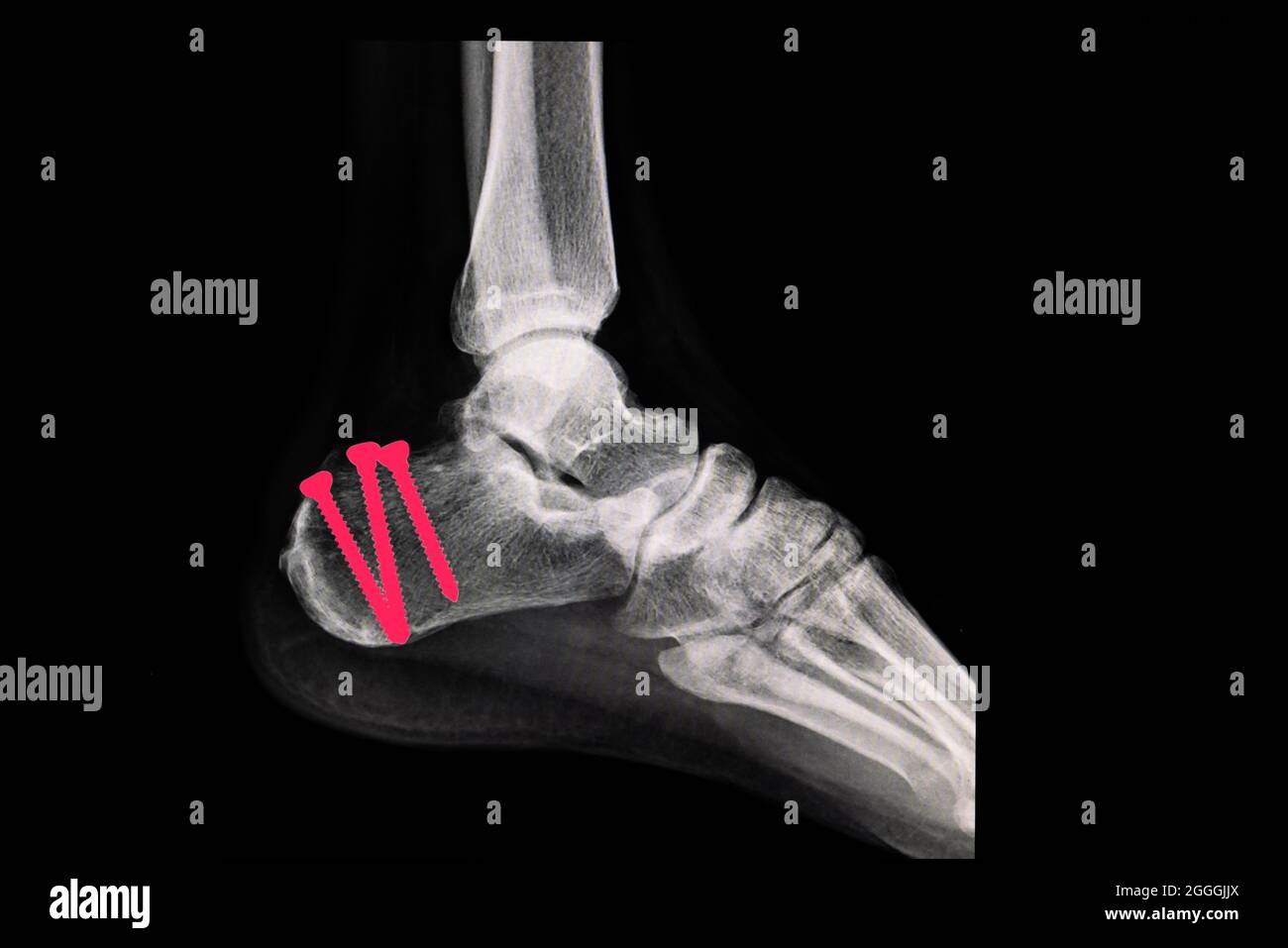 Pellicola radiogena di un piede del paziente con calcaneo fratturato (osso del tallone) dopo l'intervento chirurgico. Le viti di fissaggio sono illustrate in rosso chiaro. Foto Stock