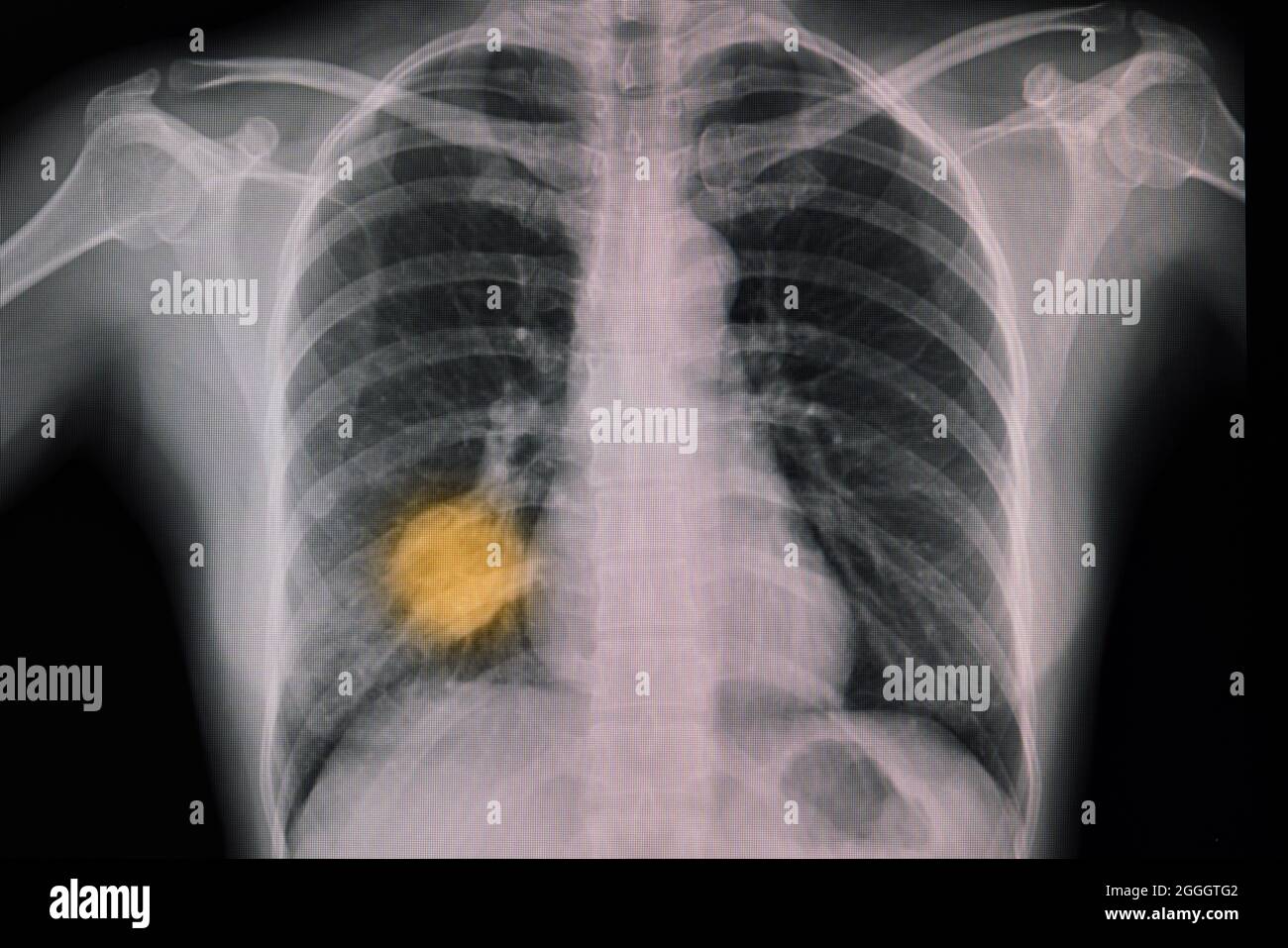 La radiografia toracica di un paziente con tumore polmonare primario e polmonite mostra un cerotto di opacità nel lobo inferiore destro e una lesione di massa nel lobo centrale destro Foto Stock
