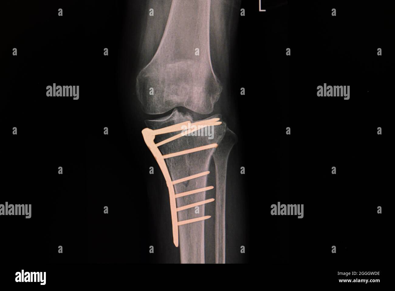 Pellicola radiogena di un ginocchio di un paziente con tibia prossimale fratturata dopo il fissaggio della piastra e delle viti. Foto Stock