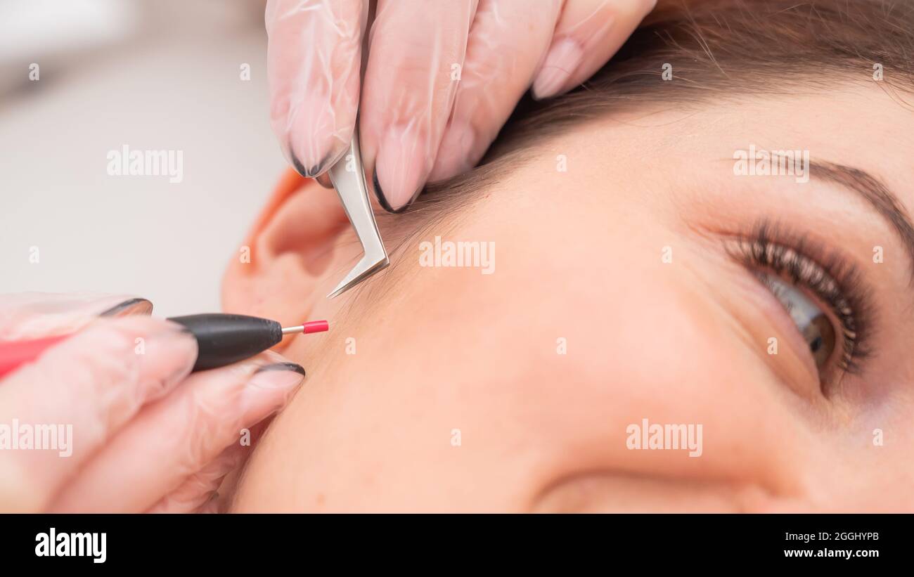 Donna in elettroepilazione del viso. Rimozione permanente dei peli  superflui in salone Foto stock - Alamy