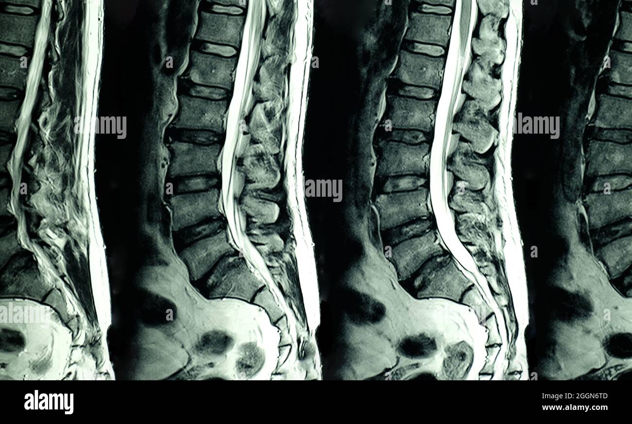 Scansione MRI delle spine lombari di un paziente con dolore cronico alla schiena che mostra un cambiamento degenerativo delle spine lombari, ernia del disco lombare e compo della radice nervosa Foto Stock