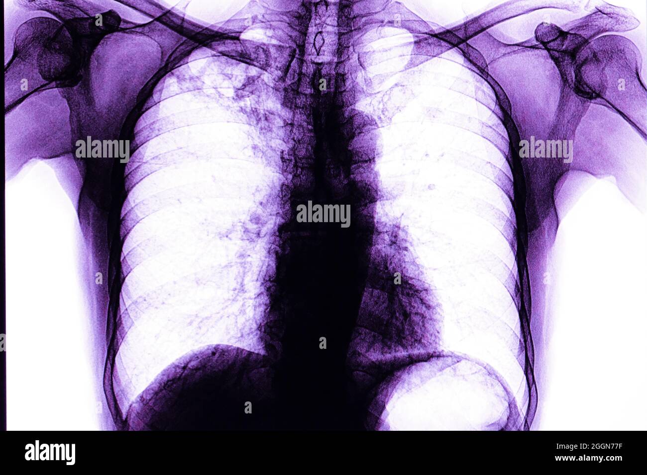 Pellicola radiogena toracica di un paziente affetto da tubercolosi nel polmone superiore destro. Foto Stock Pellicola radiogena toracica di un paziente affetto da tubercolosi nel polmone superiore destro. Foto Stock