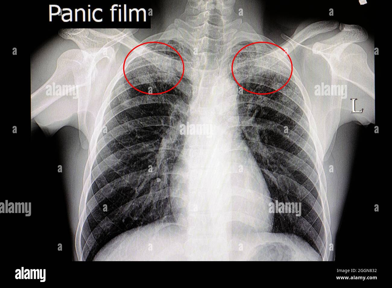 Pellicola radiogena di un pateint con tubercolosi polmonare Foto Stock