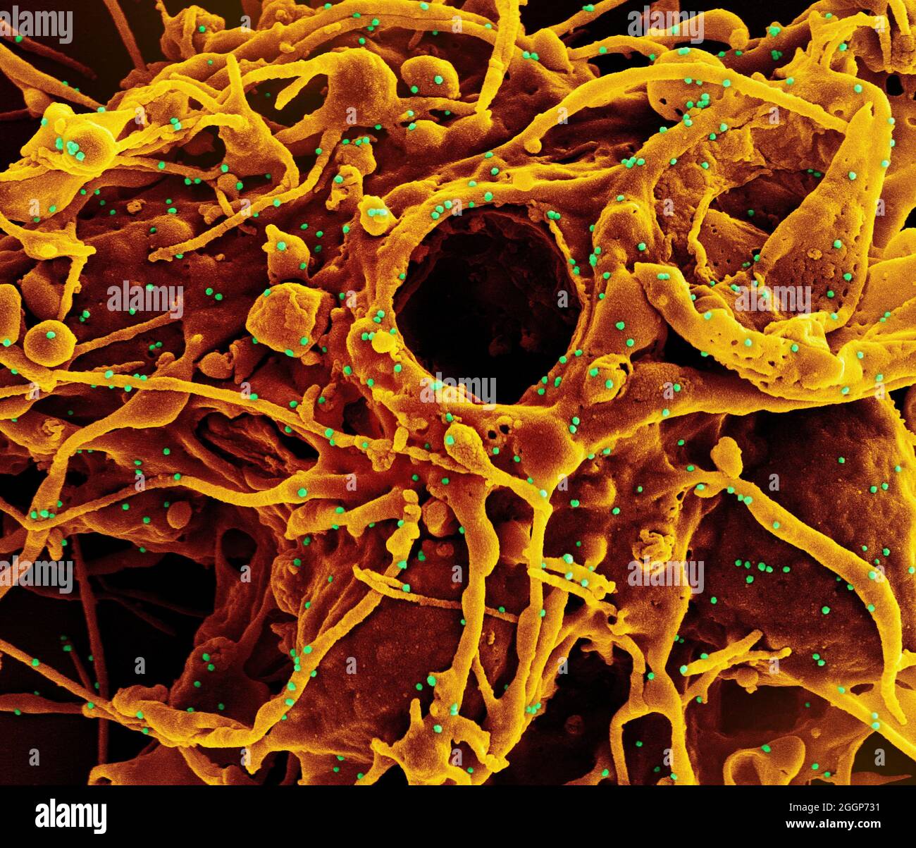 Micrografia elettronica a scansione colorata di una cellula (arancione) infettata da UK B. Foto Stock