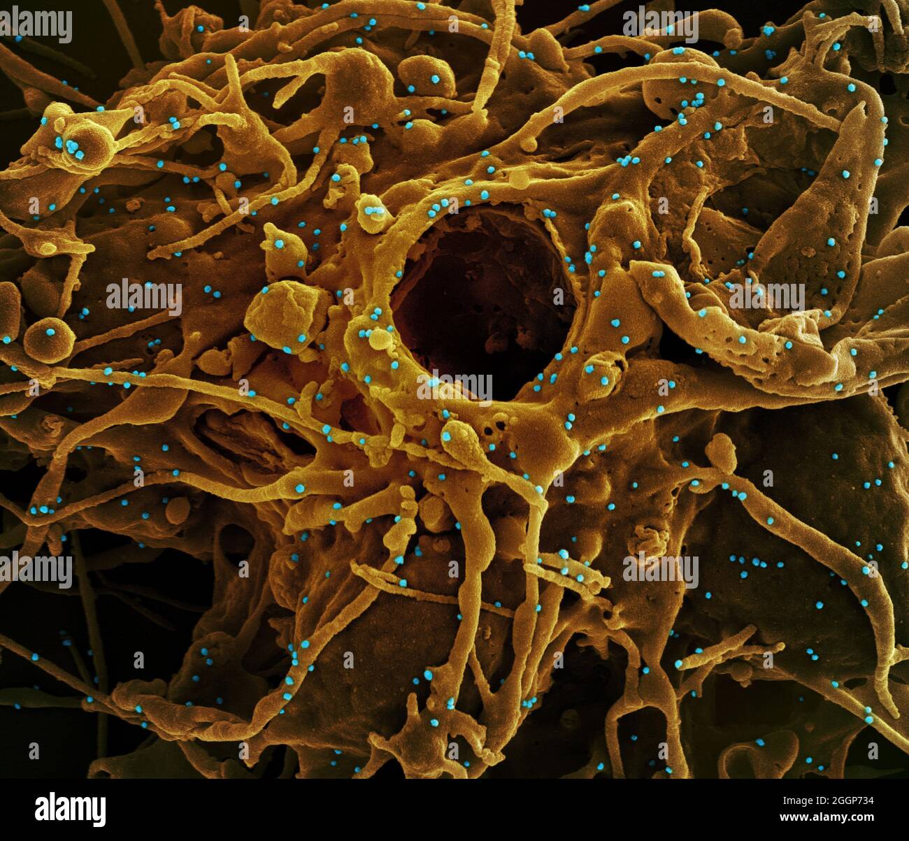 Micrografia elettronica a scansione colorata di una cellula (gialla infetta da UK B. Foto Stock