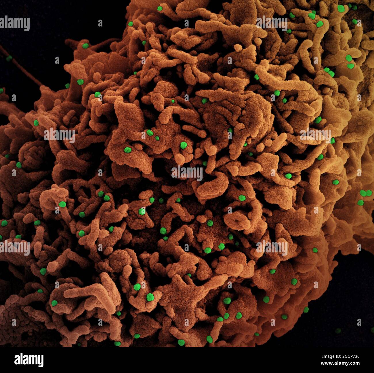 Micrografia elettronica a scansione colorata di una cellula (marrone) infettata con UK B. Foto Stock