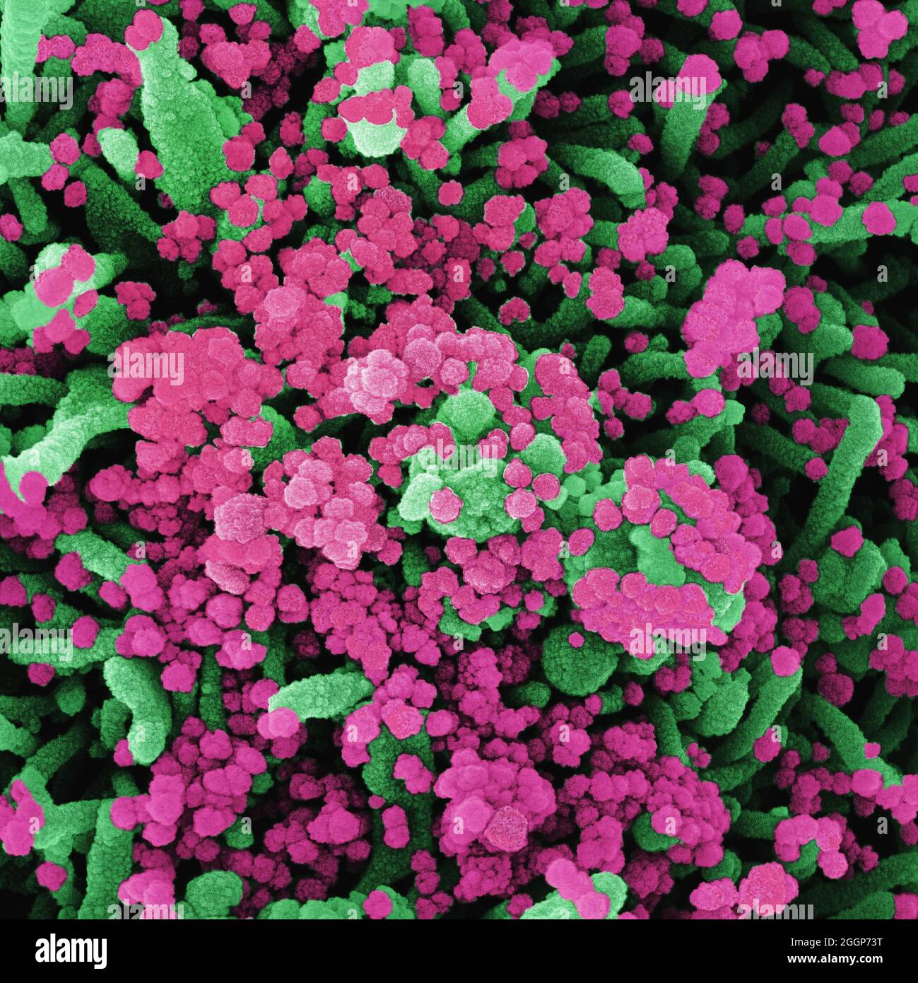 Micrografia elettronica a scansione di una cellula fortemente infettata da particelle di virus SARS-COV-2 (rosa), isolate da un campione di paziente. Foto Stock