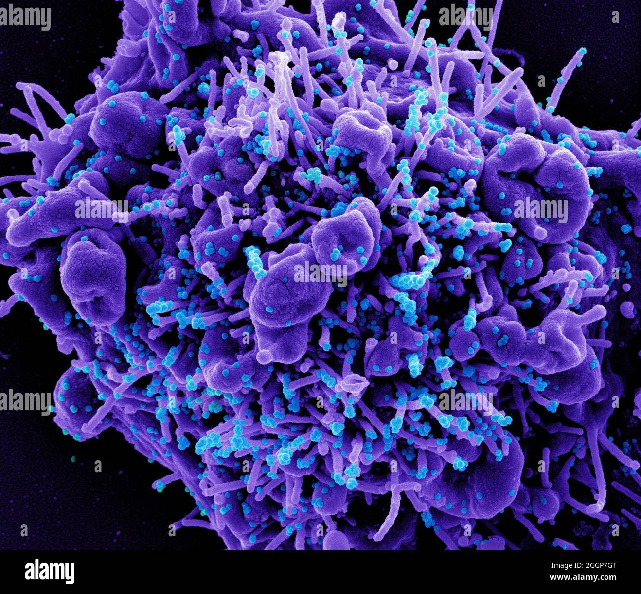 Micrografia elettronica a scansione colorata di una cellula apoptotica (viola) infettata con particelle di virus SARS-COV-2 (blu), isolate da un campione di paziente. Foto Stock