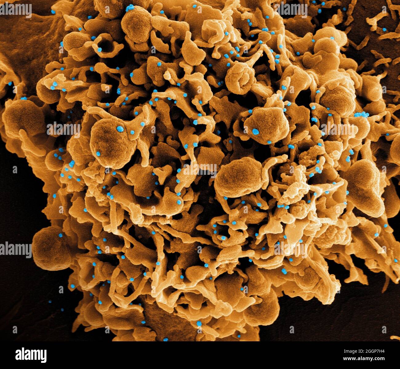 Micrografia elettronica a scansione colorata di una cellula (marrone) infettata con particelle di virus SARS-COV-2 (blu), isolata da un campione di paziente. Foto Stock