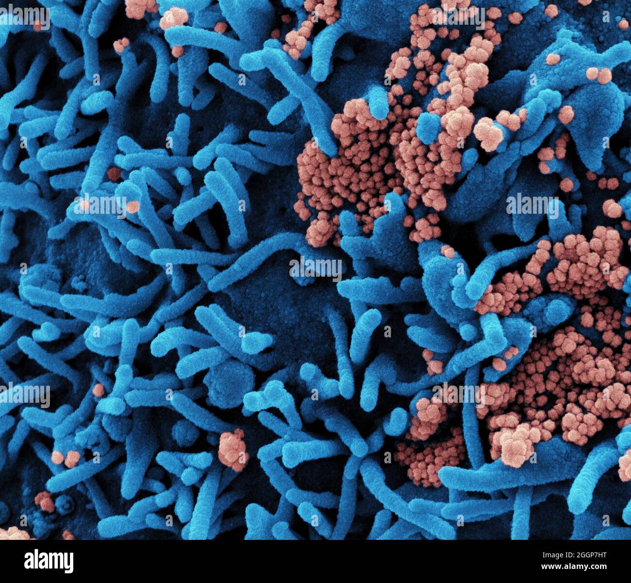 Micrografia elettronica a scansione colorata di una cellula (blu) infettata con particelle di virus SARS-COV-2 (rosa), isolata da un campione di paziente. Foto Stock