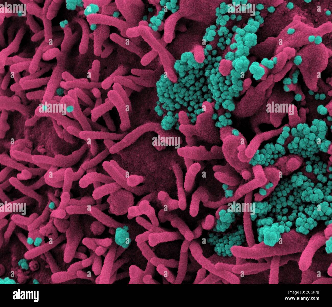 Micrografia elettronica a scansione colorata di una cellula (rosa) infettata con particelle di virus SARS-COV-2 (teal), isolata da un campione di paziente. Foto Stock