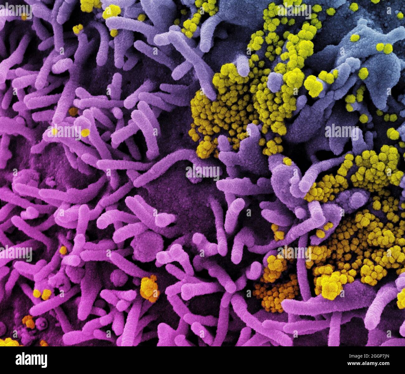 Micrografia elettronica a scansione colorata di una cellula (viola) infettata con particelle di virus SARS-COV-2 (giallo), isolata da un campione di paziente. Foto Stock