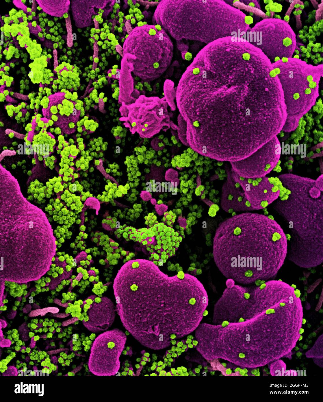 Micrografia elettronica a scansione colorata di una cellula apoptotica (rosa) fortemente infettata con particelle di virus SARS-COV-2 (verde), isolate da un campione di paziente. Foto Stock