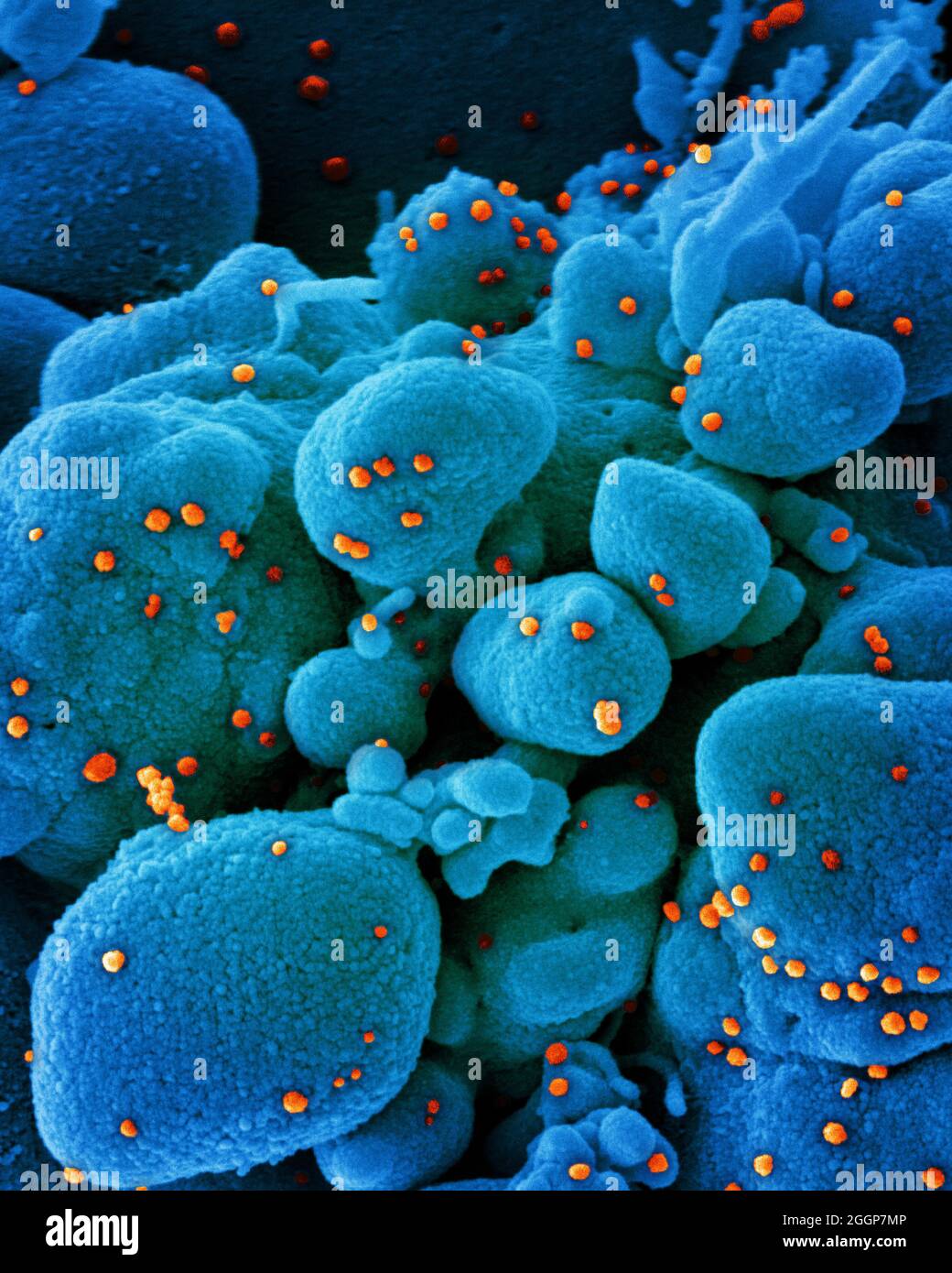 Micrografia elettronica a scansione colorata di una cellula apoptotica (blu) infettata con particelle di virus SARS-COV-2 (arancione), isolate da un campione di paziente. Foto Stock