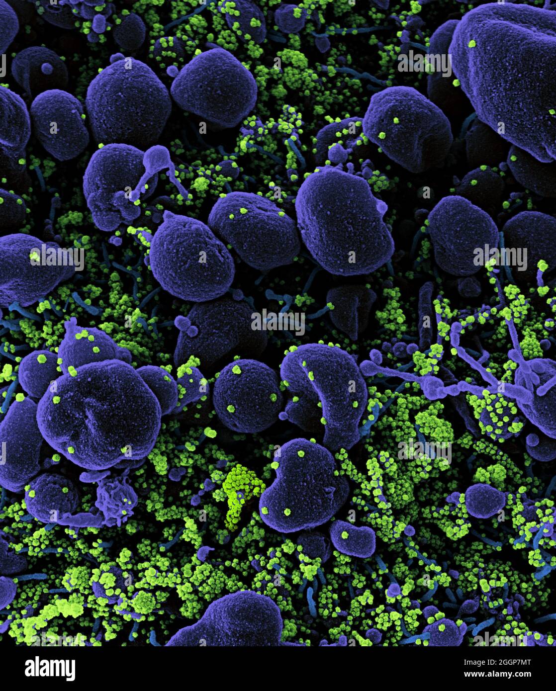 Micrografia elettronica a scansione colorata di una cellula apoptotica (viola) fortemente infettata con particelle di virus SARS-COV-2 (verde), isolate da un campione di paziente. Foto Stock