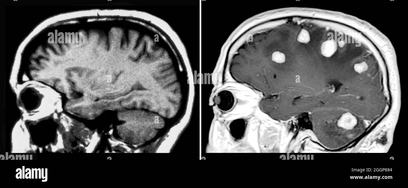 A sinistra è presente una risonanza magnetica sagittale (a partire dal  lato) pesata T1 che mostra l'anatomia normale del cervello. Sulla destra è  presente una RM di un cervello che mostra tumori