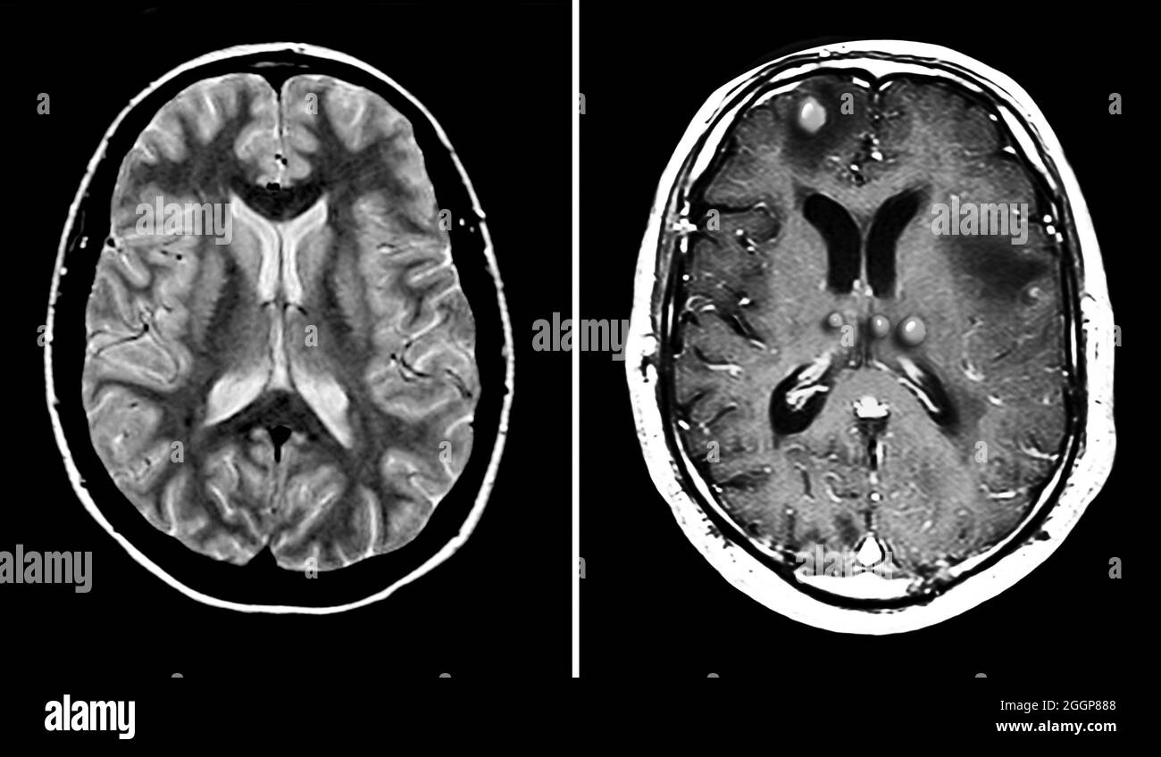 A sinistra si trova una normale immagine MRI assiale del cervello attraverso entrambi gli emisferi cerebrali. A questo livello si vedono due grandi cavità riempite di materiale scuro. Questi sono i ventricoli laterali che sono riempiti di liquido spinale cerebrale (CSF). Ci sono due tipi principali di tessuto cerebrale, la materia grigia (che contiene i corpi delle cellule neuronali ed è il più scuro del tessuto cerebrale mostrato) e la materia bianca (che è composta da fibre assonali). A destra è presente una scansione RM assiale di un cervello che mostra tumori maligni multipli. Questi noduli tumorali sono circondati da un esteso gonfiore. Foto Stock