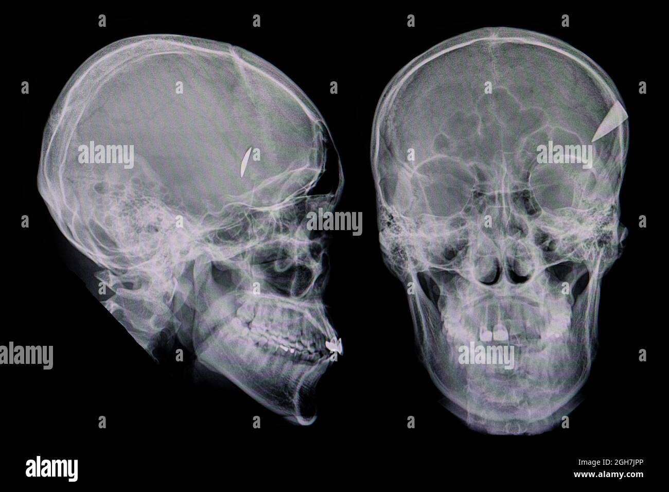 Pellicole radiografiche di un paziente con una punta di un coltello che trattiene il cranio. Lesioni da penetrazione del cranio. Foto Stock