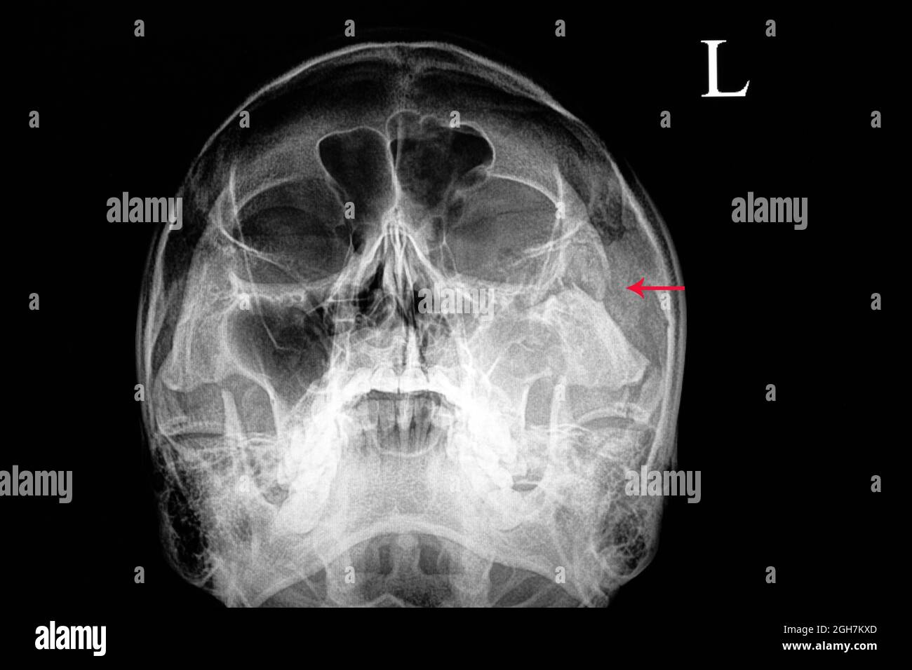 pellicola radiogena di un cranio di un paziente affetto da lesione traumatica che mostra fratture dell'osso zigomatico sinistro e sinusite traumatica Foto Stock