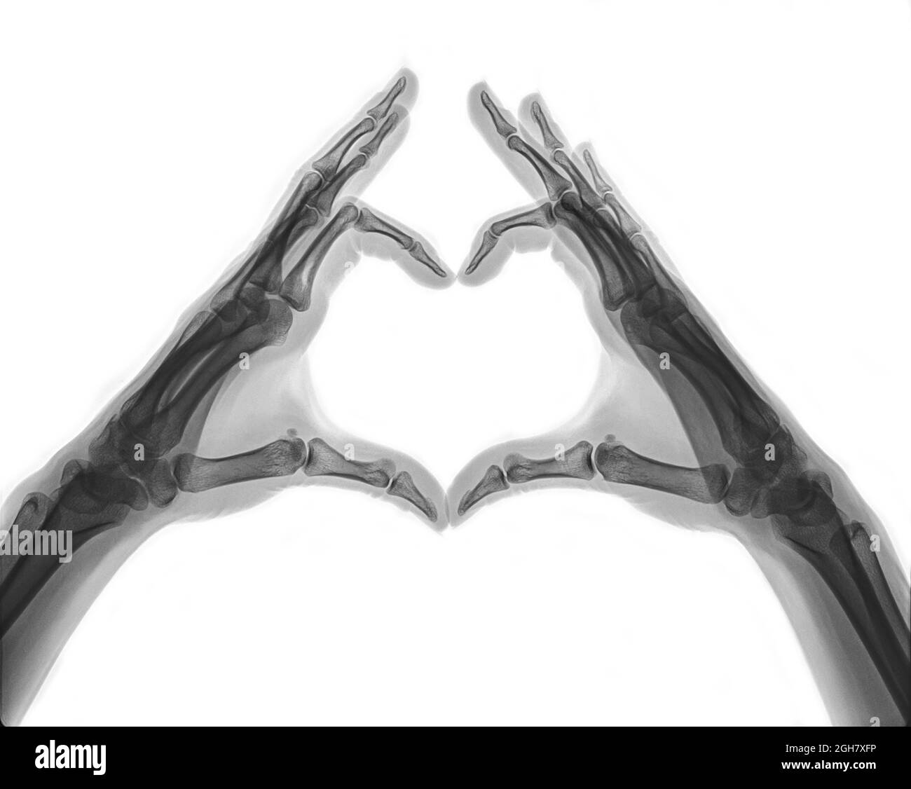 Raggi X delle mani che formano una forma cardiaca Foto Stock