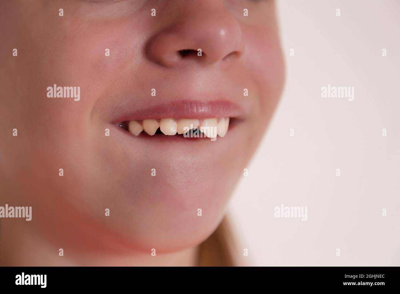 La visita del bambino al dentista. Due denti femmina anteriori sono rotti. Foto Stock