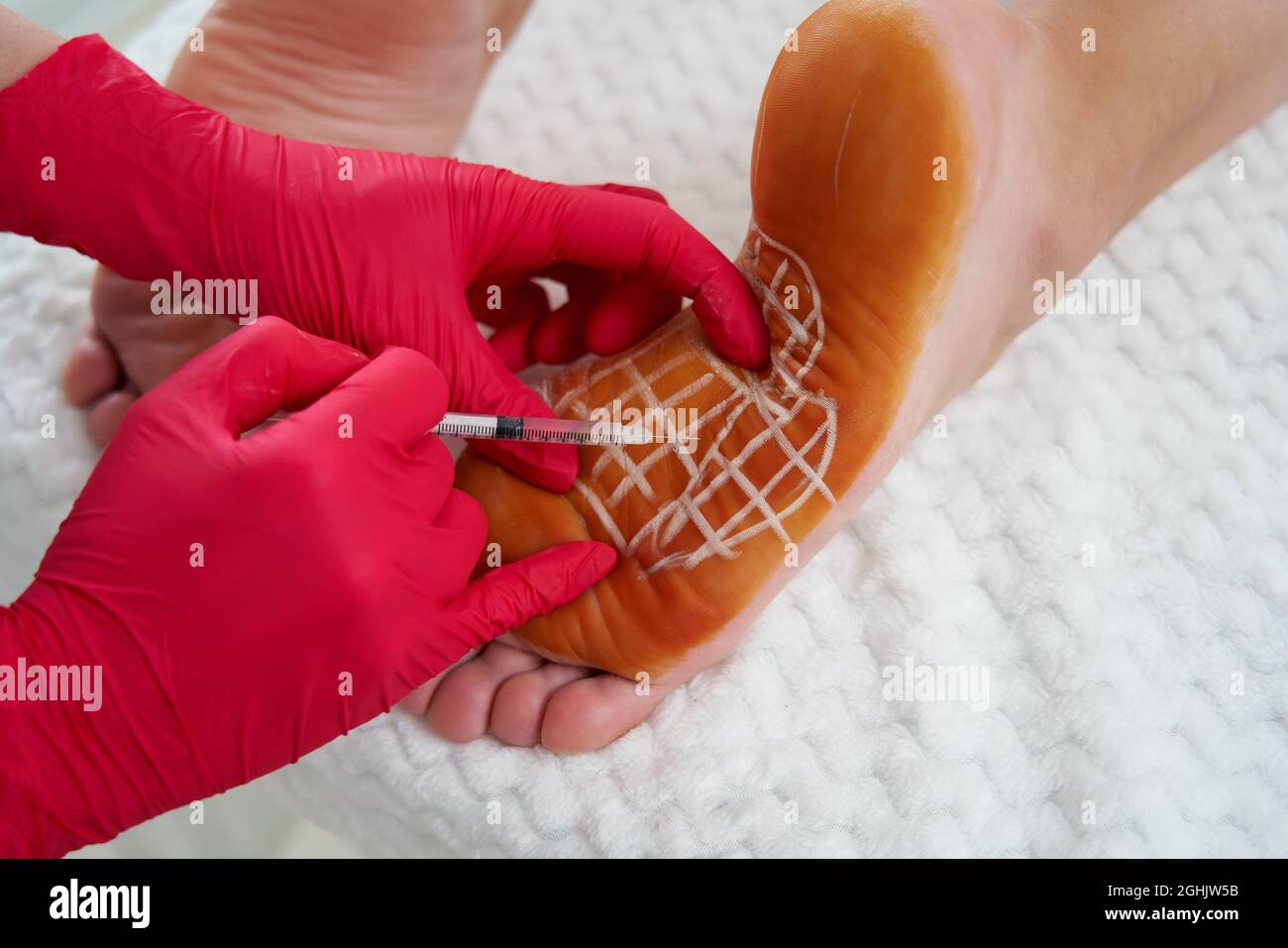 Il medico effettua iniezioni intramuscolari di tossinone botulino nei piedi  femminili contro iperidrosi, sudorazione eccessiva Foto stock - Alamy