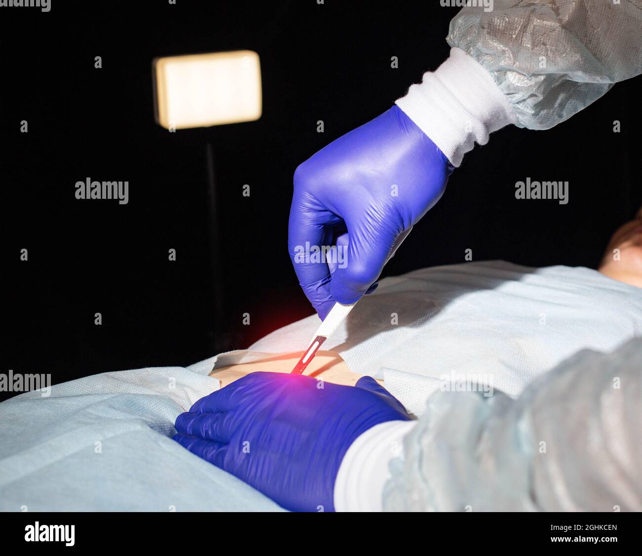 Medico chirurgo con un bisturi in mano prima di chirurgia intestinale in un paziente, primo piano. Concetto di rimozione della parte dell'intestino tenue e trattamento della malattia dell'intestino tenue Foto Stock