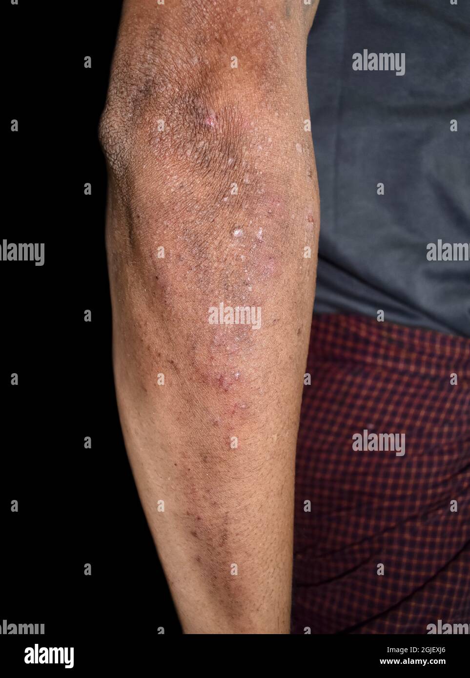 Dermatite alcolica dovuta a carenza di niacina o vitamina B3 con conseguente pellagra. Pelle ruvida e asciutta dell'avambraccio. Foto Stock