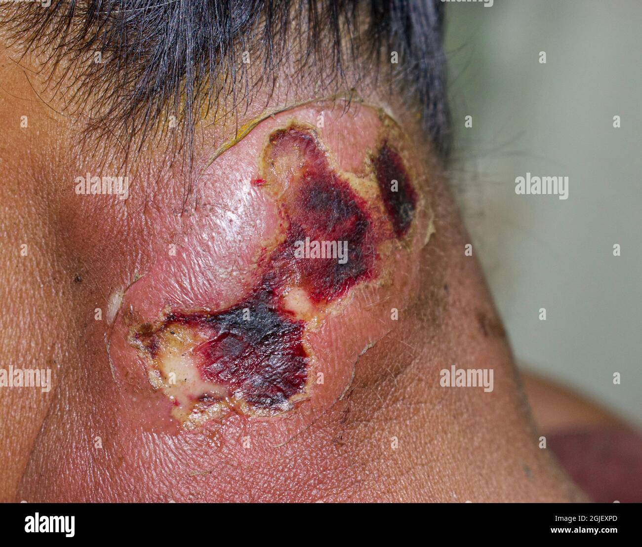 Ascesso grande con cellulite circostante o Staphylococcal, infezione della pelle Streptococcal al collo della paziente femminile birmana asiatica. Foto Stock