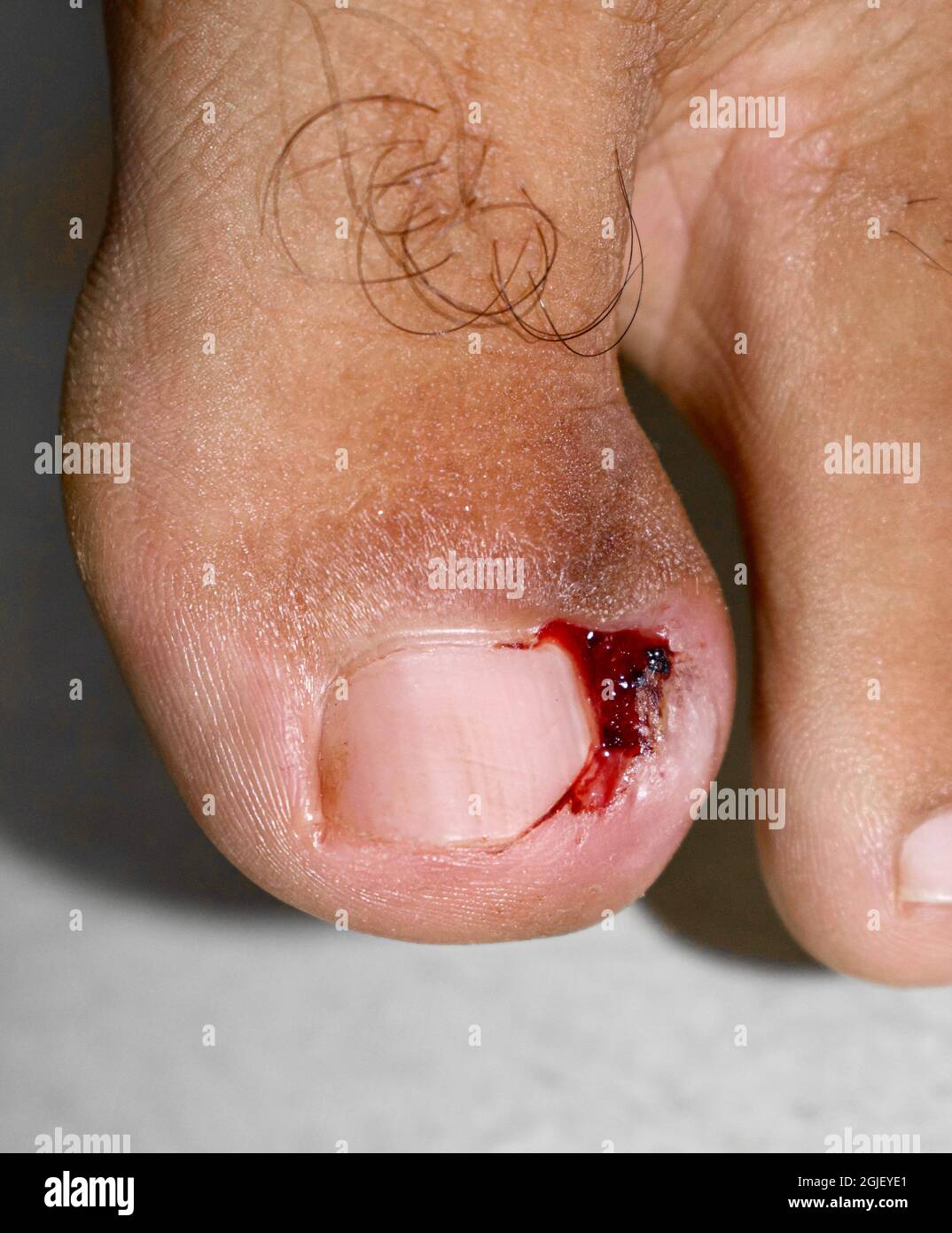 Paronichia alle dita dell'uomo asiatico. È un'infezione dolorosa. Foto Stock