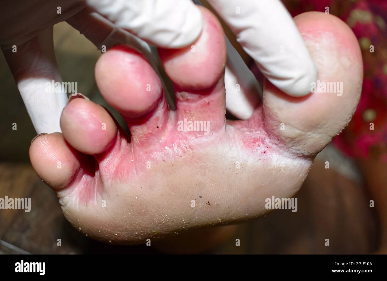 Infezione fungina chiamata tinea pedis ai piedi della donna asiatica. È lesione da prurito. Foto Stock