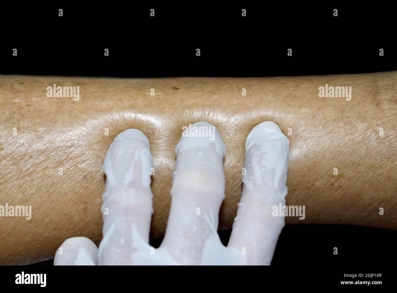 Edema da vaiolatura dell'arto inferiore. Gamba gonfia di donna asiatica. Isolato su nero. Foto Stock
