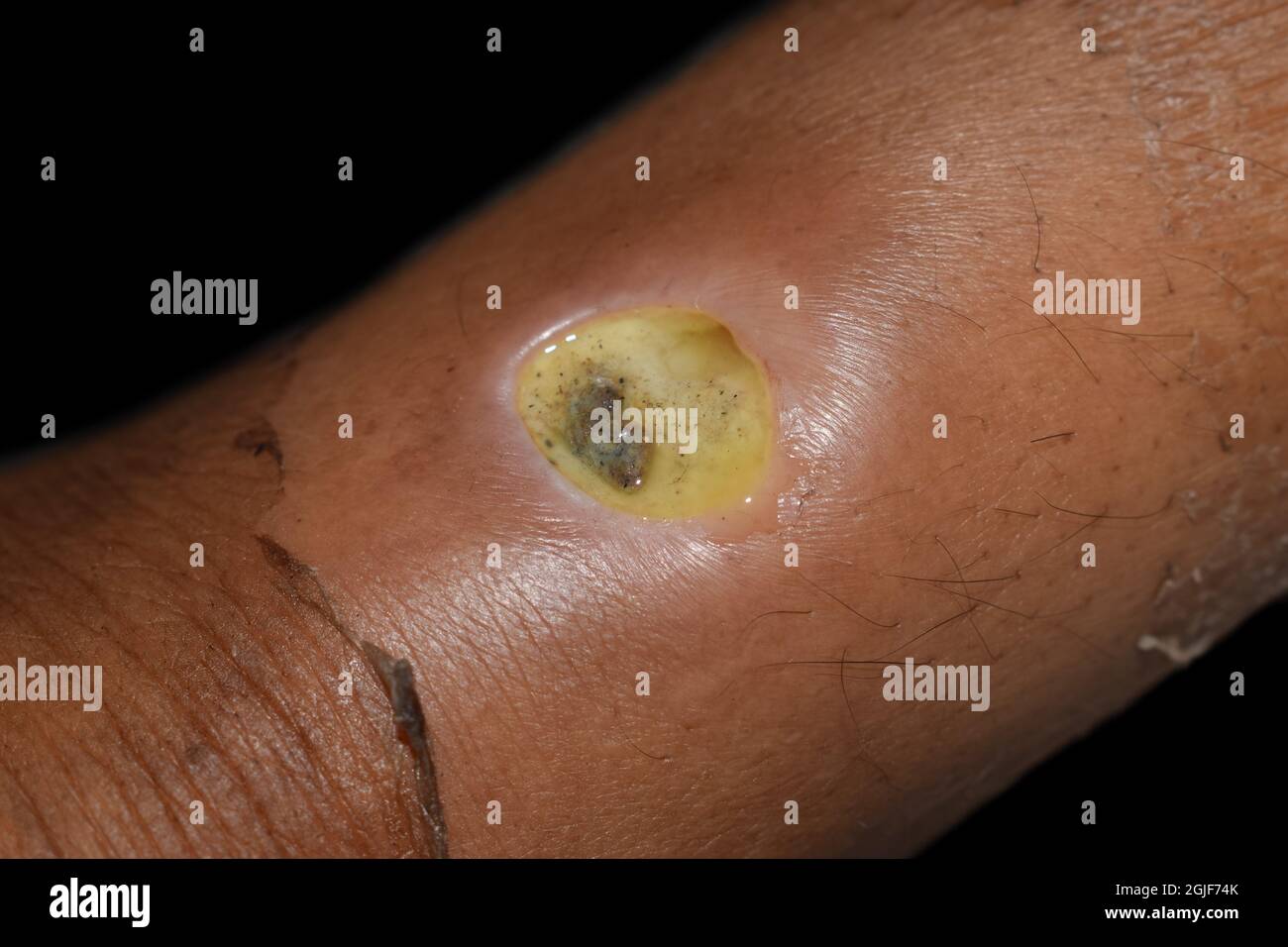 Ulcera diabetica nella gamba del paziente asiatico. Scarsa guarigione della ferita. Isolato su nero. Foto Stock