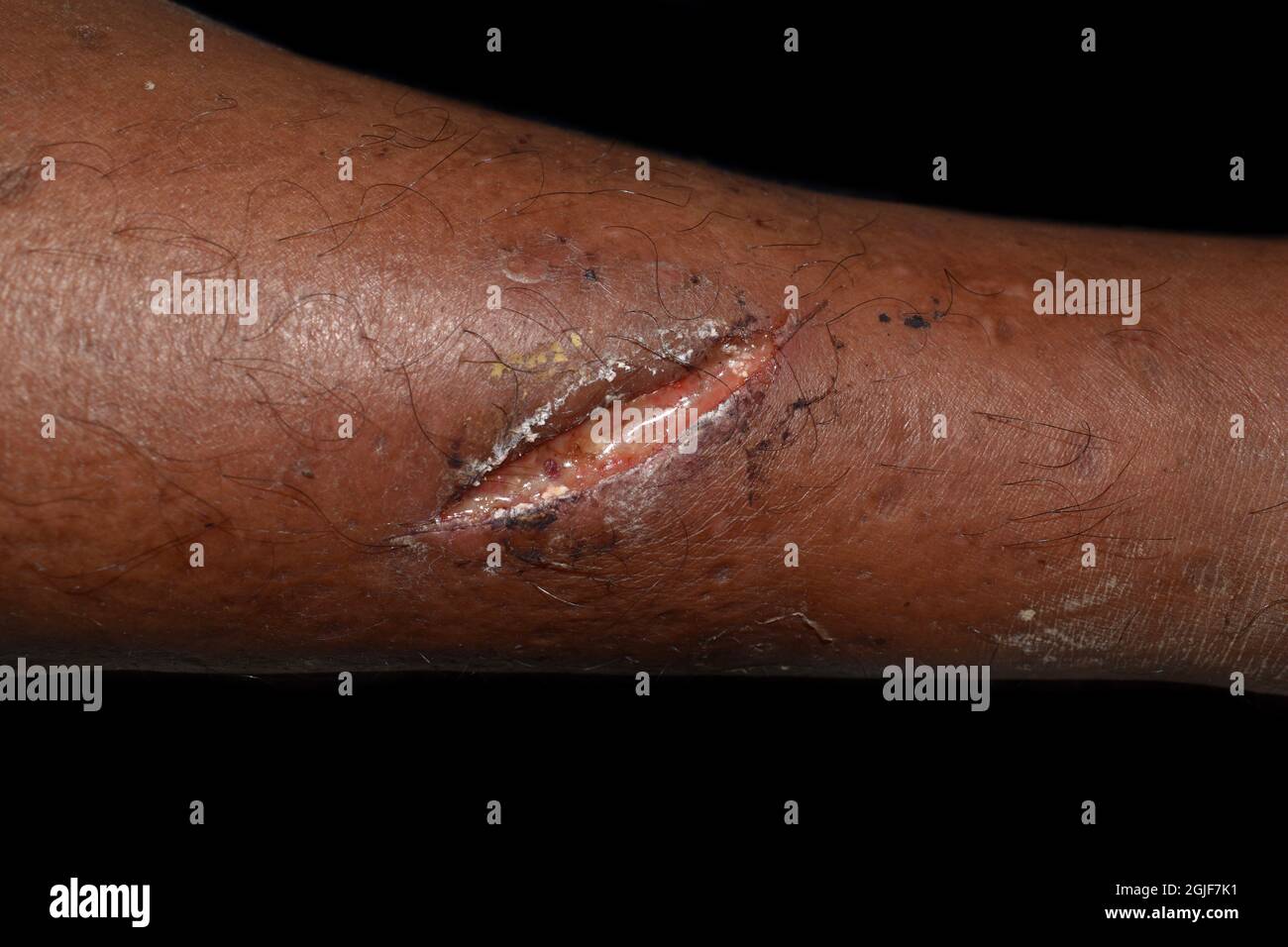 Scarsa guarigione della ferita o guarigione secondaria della ferita con gap di ferite di grandi dimensioni. Infezione della ferita. Isolato su nero. Foto Stock