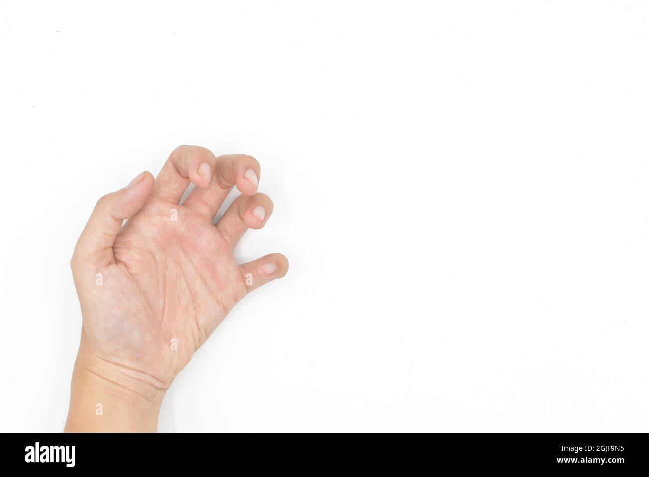 Spasmo muscolare della mano nel giovane asiatico. Deformità unilaterale della mano. Flessione anomala delle dita. Isolato su sfondo bianco. Spazio di testo presente. Foto Stock