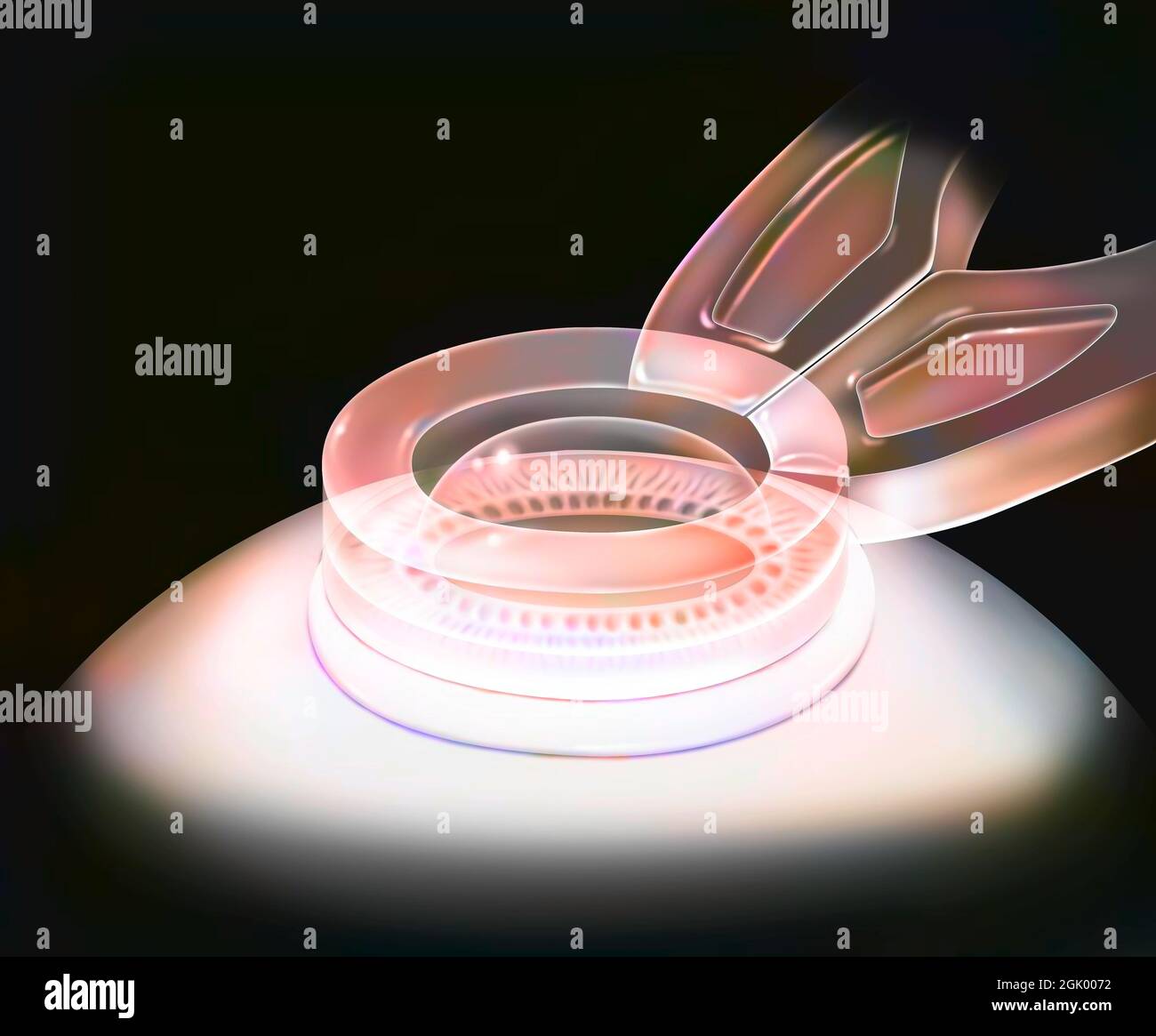 Occhio (chirurgia rifrattiva), Lasik: Anello di aspirazione per laser femtosecondi. Foto Stock
