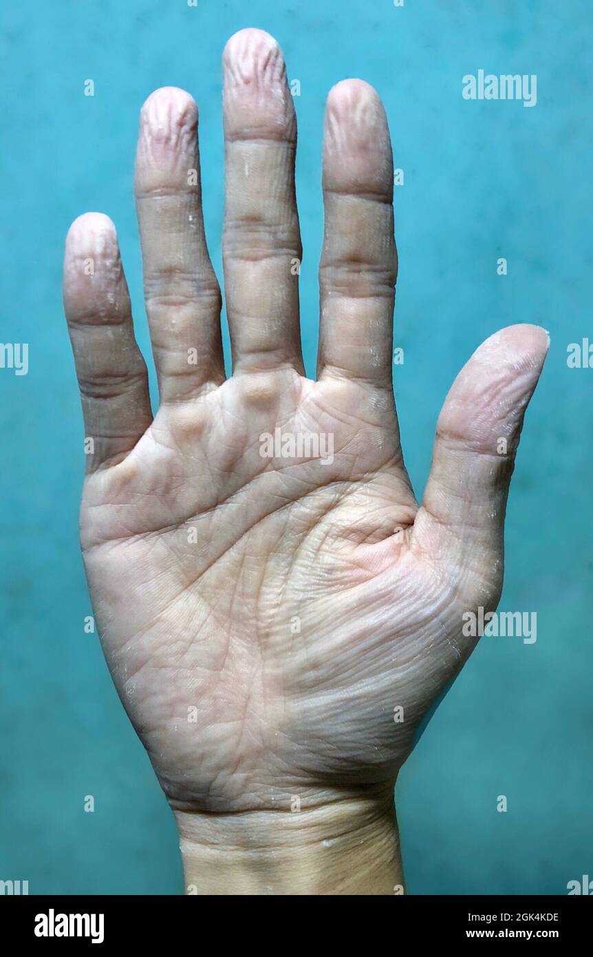 Pruney mano a causa di lungo immersione in acqua. La pelle della mano si restringe. Mano malsana. Foto Stock