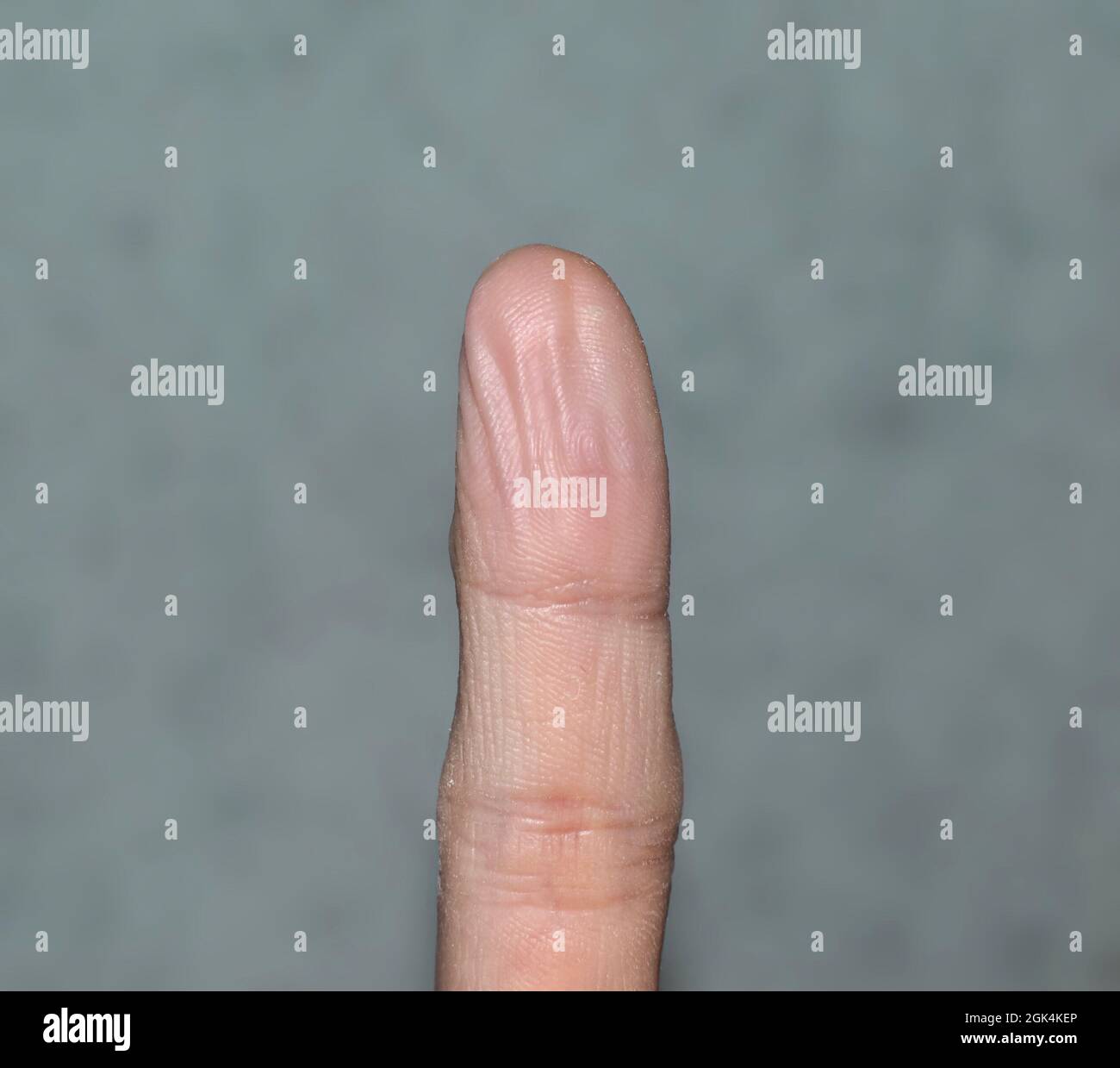 Pruney dito a causa di lungo immersione in acqua. La pelle della mano si restringe. Mano malsana. Foto Stock