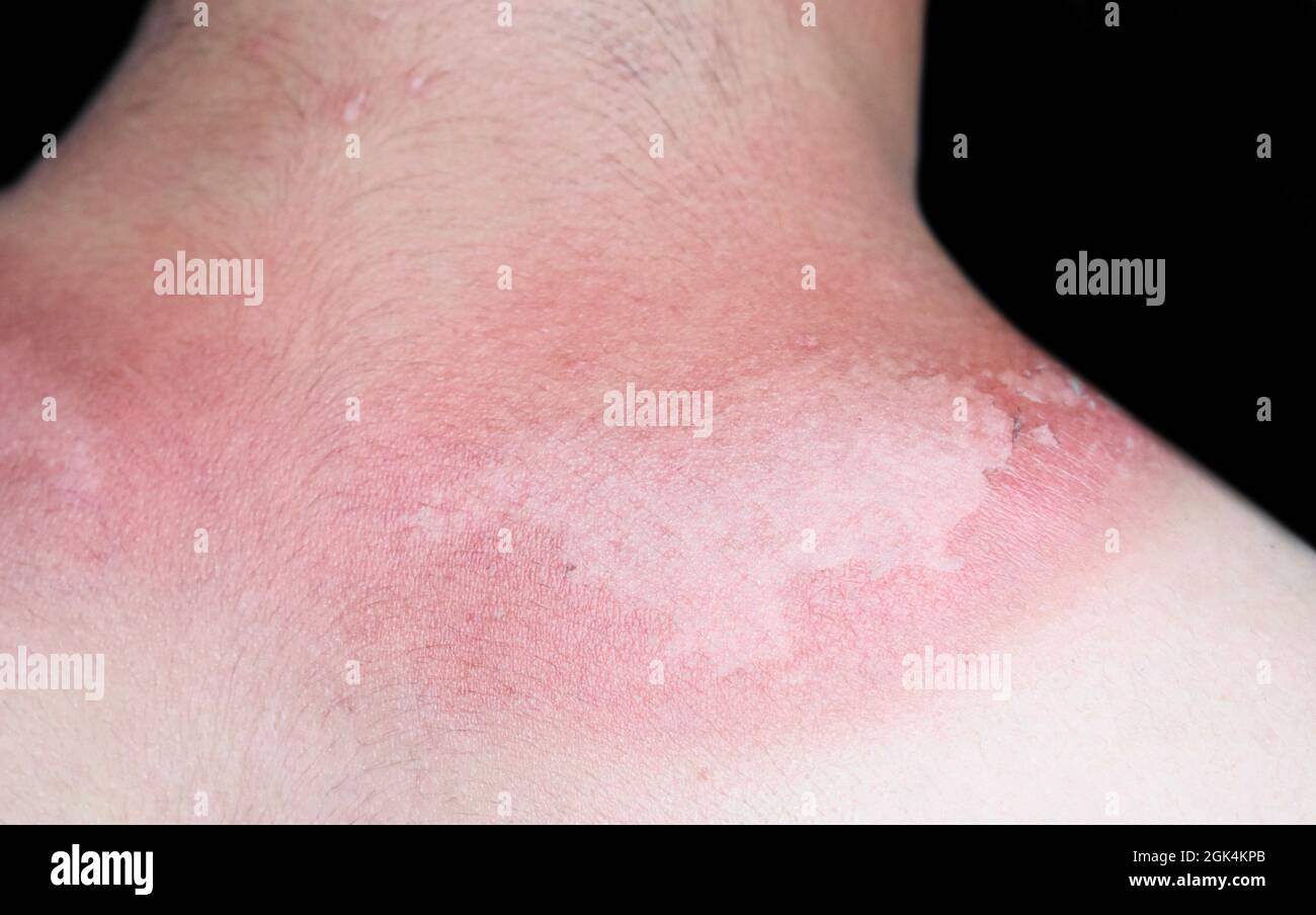 Sunburn peeling scolorimento o dermatite da scottatura solare nella parte superiore della parte posteriore del giovane asiatico. Foto Stock